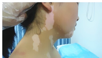 青少年白癜风吃什么药效果显著