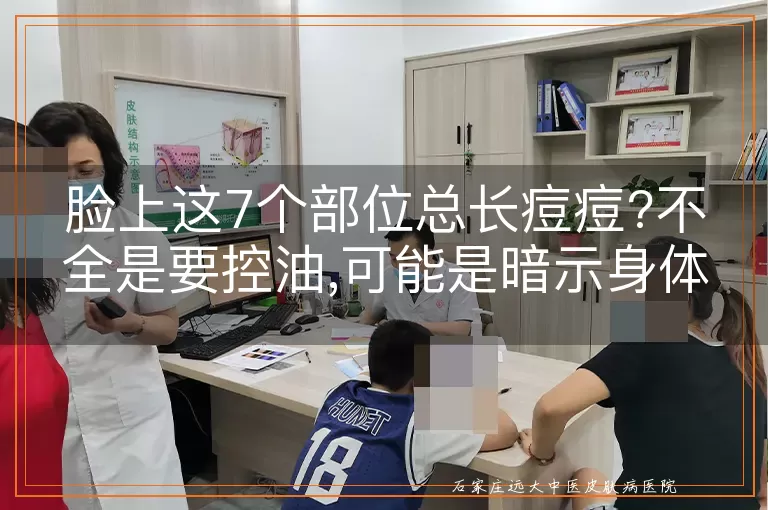 脸上这7个部位总长痘痘?不全是要控油,可能是暗示身体出了问题