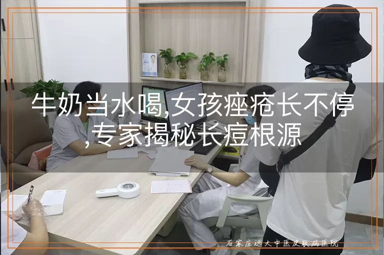 牛奶当水喝,女孩痤疮长不停,专家揭秘长痘根源