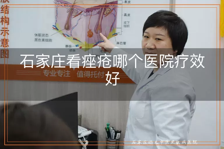 石家庄看痤疮哪个医院疗效好