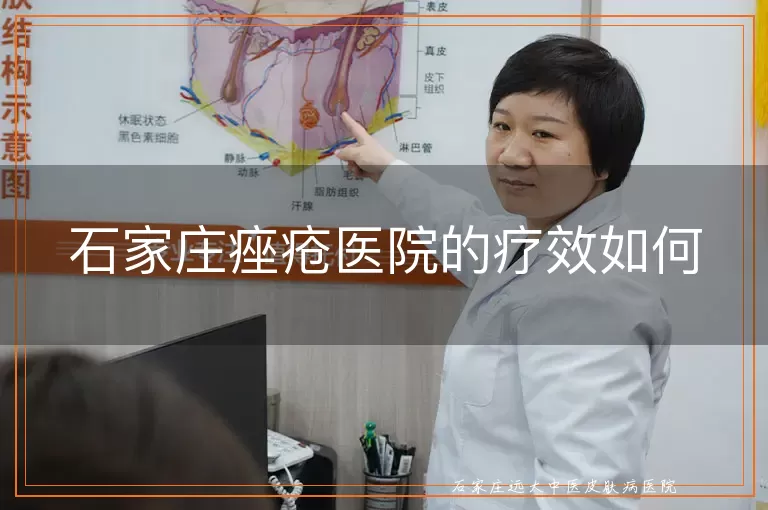 石家庄痤疮医院的疗效如何