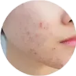 炎性丘疹