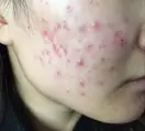 红色痘印