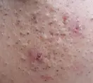 增生性痘印