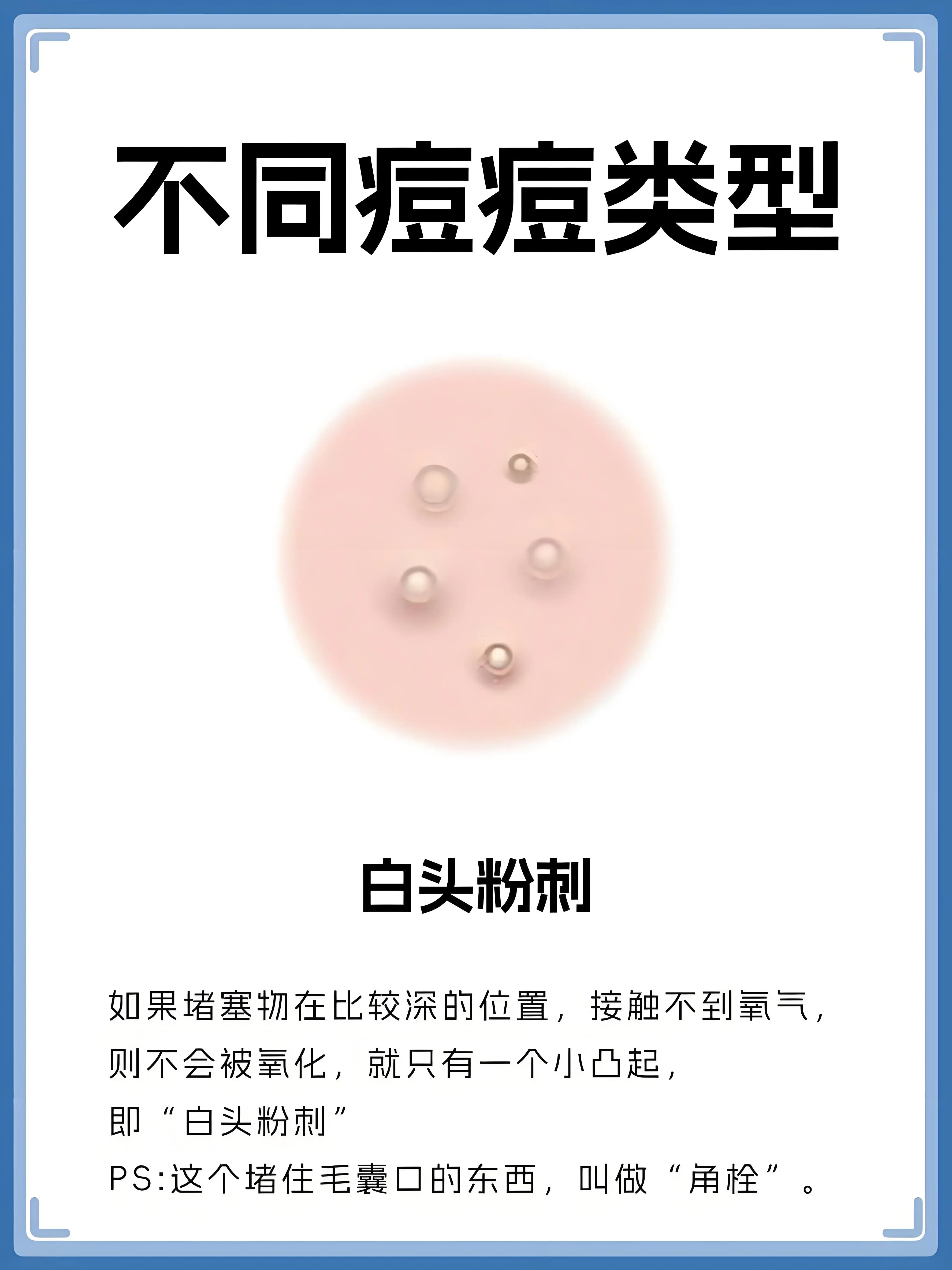 如果堵塞物在比较深的位置，接触不到氧气则不会被氧化，就只有一个小凸起即“白头粉刺”。