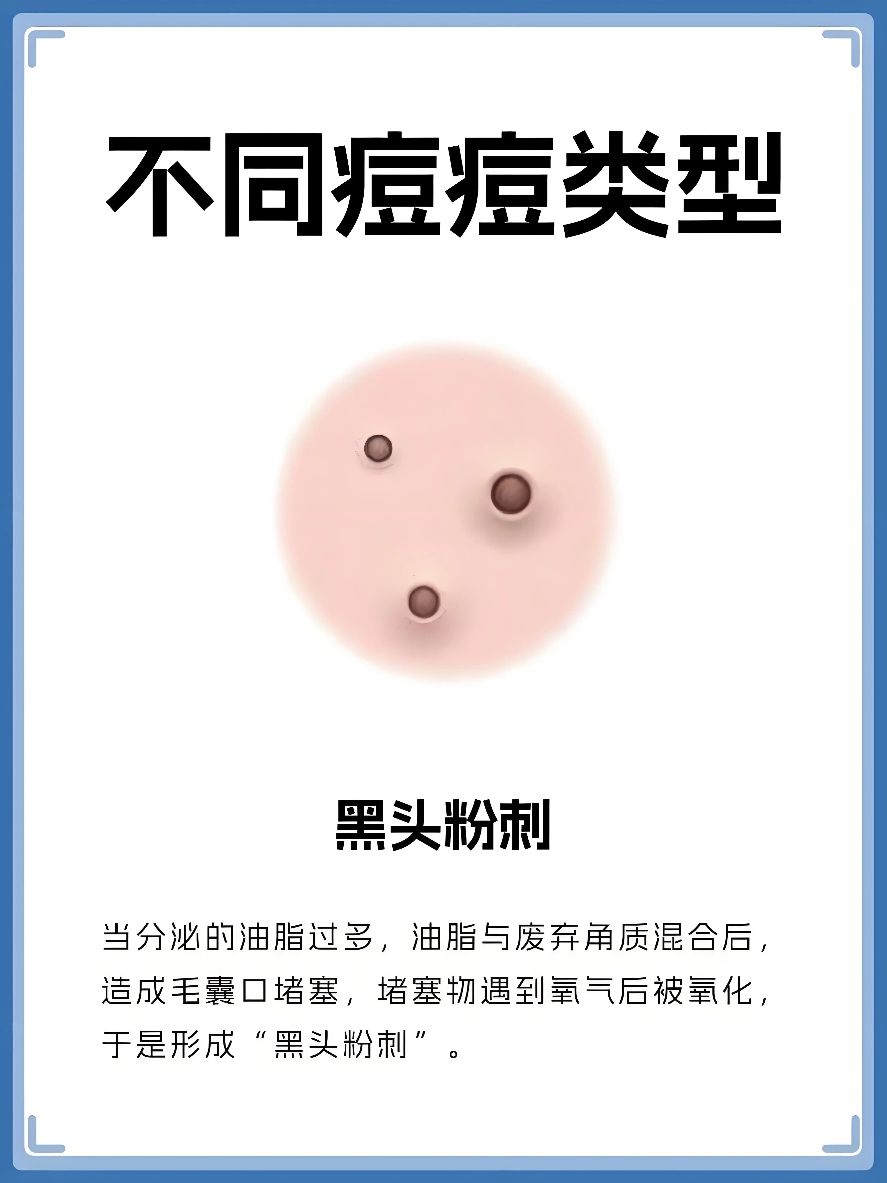 当分泌的油脂过多，油脂与废弃角质混合后造成毛囊口堵塞，堵塞物遇到氧气后被氧化于是形成“黑头粉刺”。