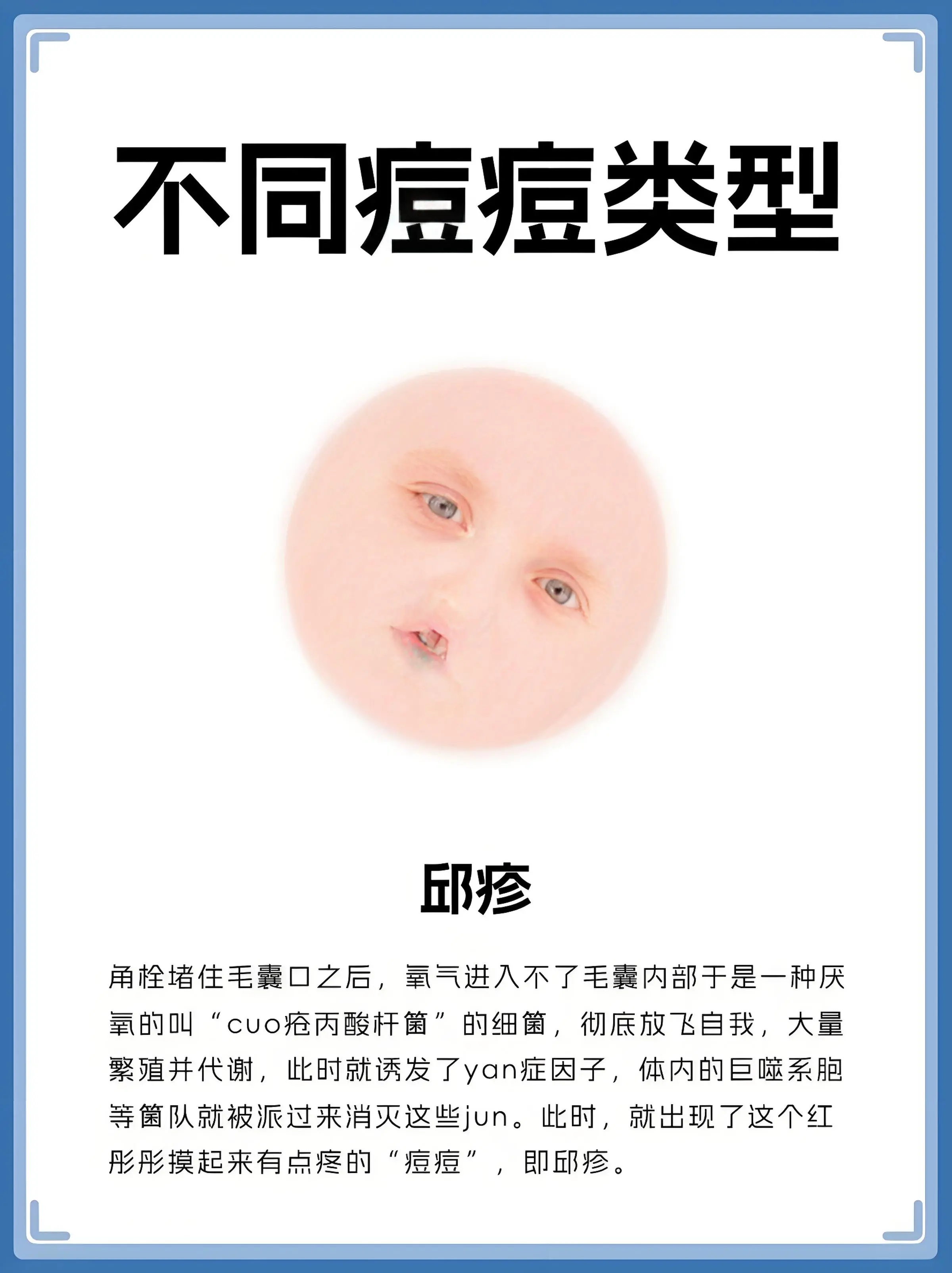 角栓堵住毛囊口之后，氧气进入不了毛囊内部于是一种厌氧的叫“cvo疮丙酸杆”的细，彻底放飞自我，大量繁殖并代谢，此时就诱发了yan症因子，体内的巨噬系胞等策队就被派过来消灭这些jun。此时，就出现了这个红彤彤摸起来有点疼的“痘痘”即邱疹。
