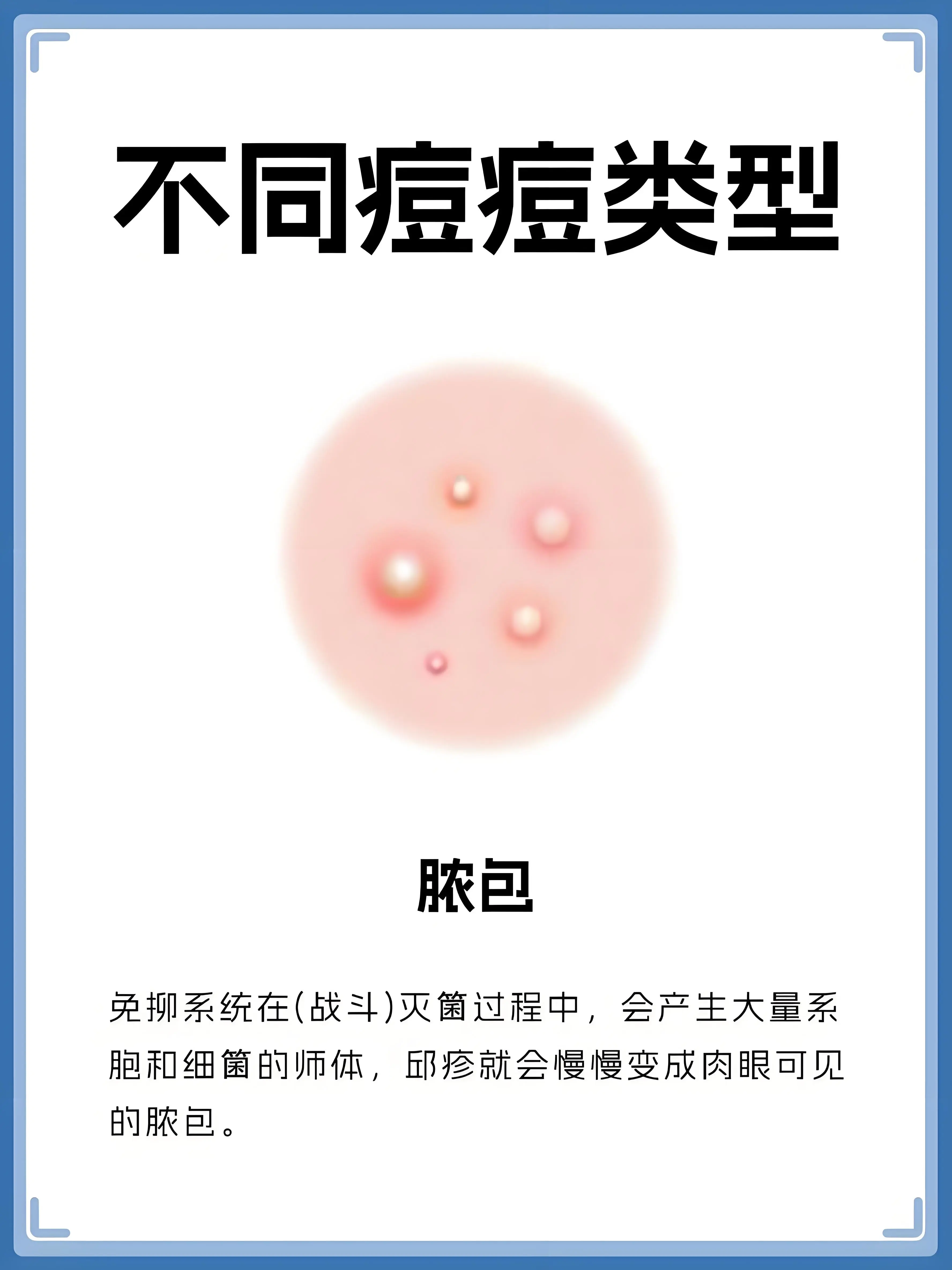 免抑系统在(战斗)灭菌过程中，会产生大量系胞和细策的师体，邱疹就会慢慢变成肉眼可见的脓包。