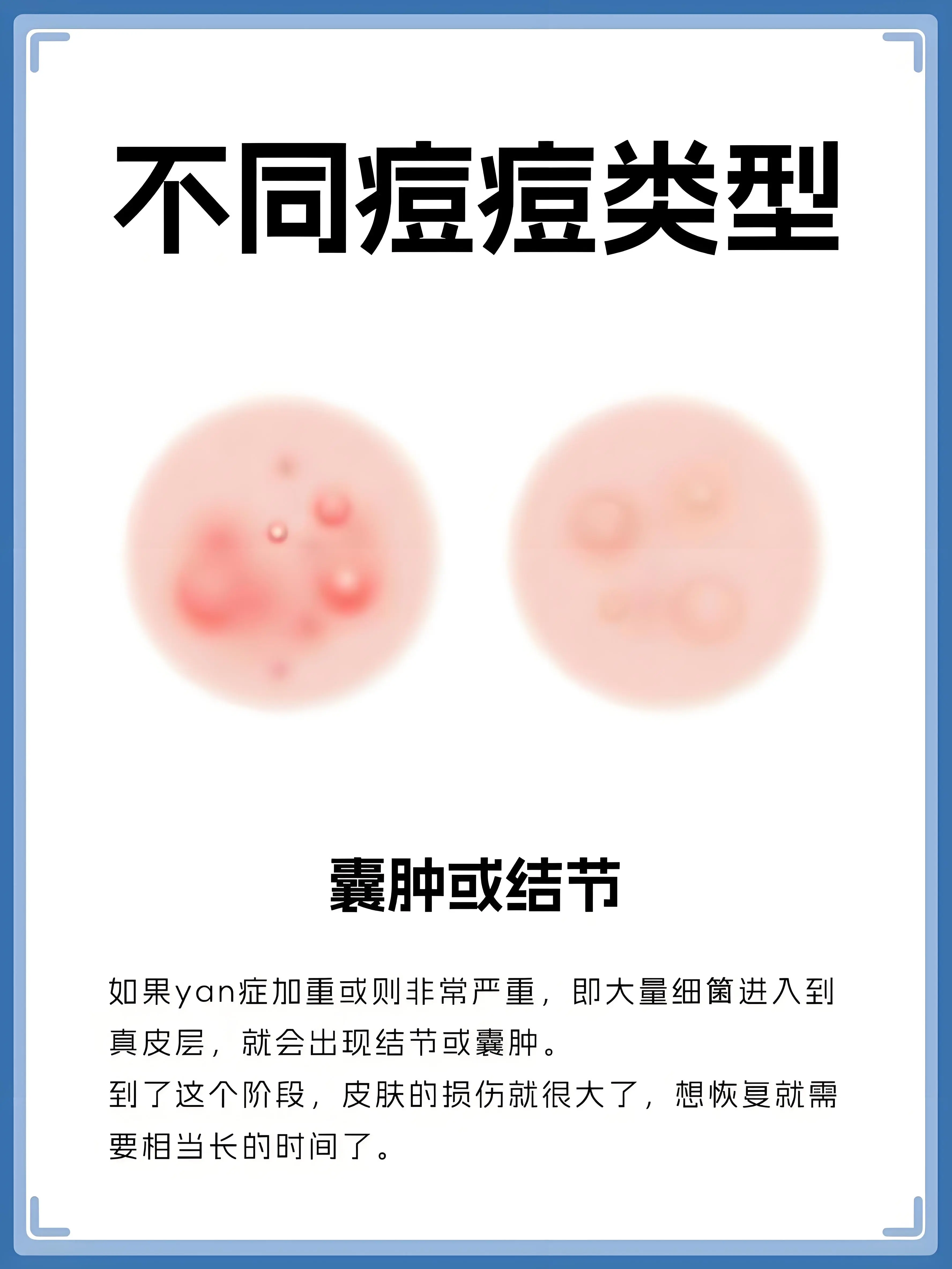 如果yan症加重或则非常严重，即大量细策进入到真皮层，就会出现结节或囊肿到了这个阶段，皮肤的损伤就很大了，想恢复就需要相当长的时间了。