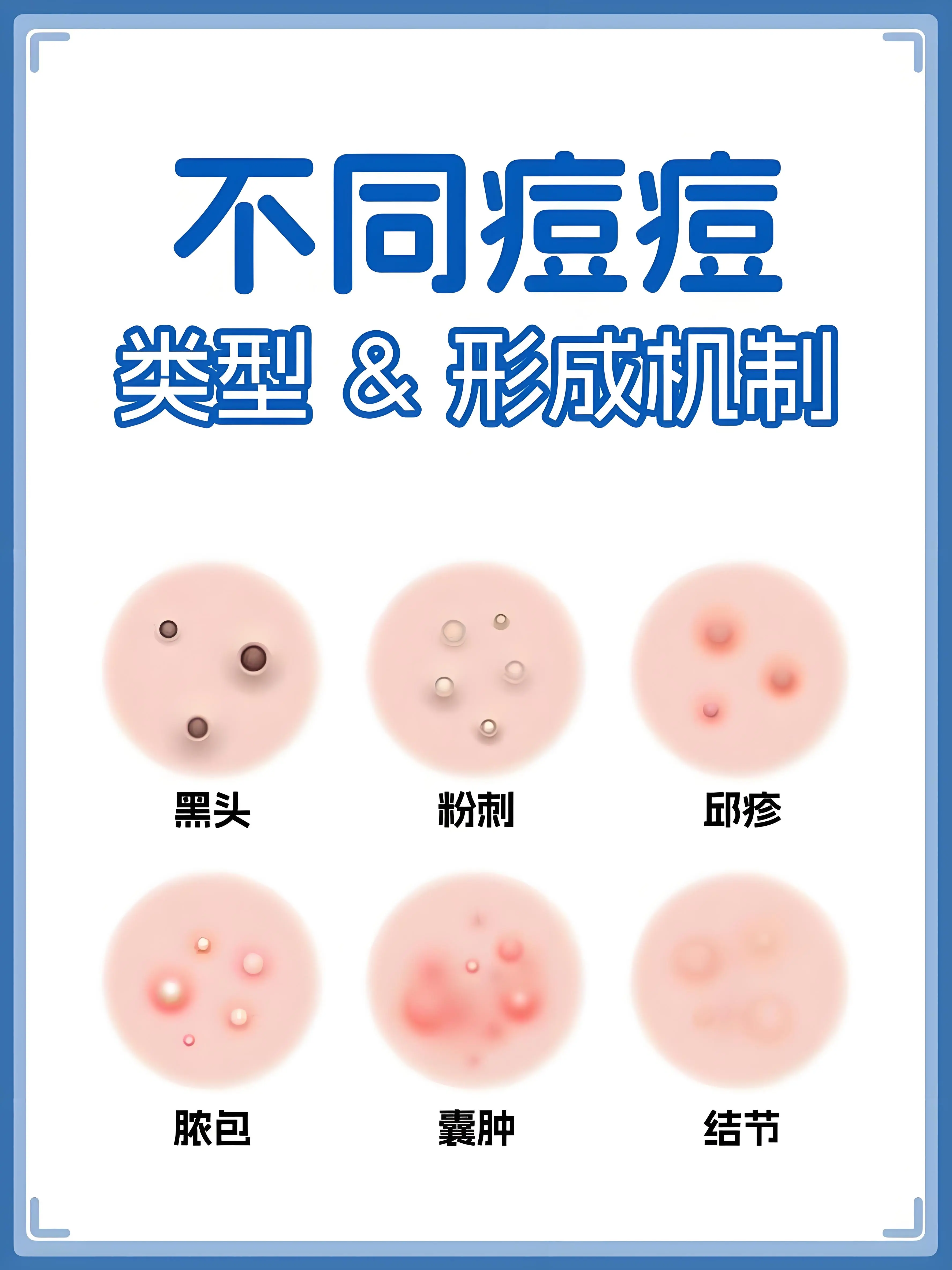 不同痘痘类型 & 形成机制